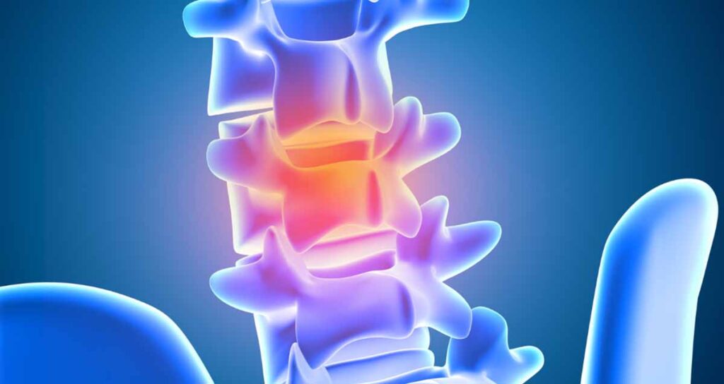 Fractured Vertebra - Dr.Jasdeep Sidana