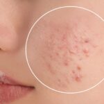 Say Goodbye to Acne: Effective Strategies for Clearing and Preventing Breakouts