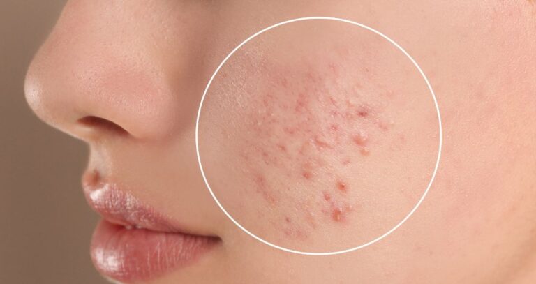 Say Goodbye to Acne: Effective Strategies for Clearing and Preventing Breakouts